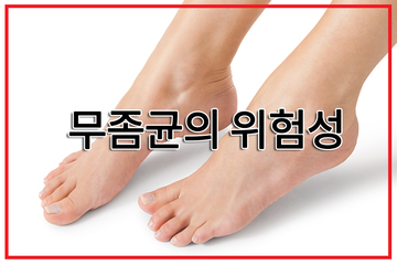 숨기고 싶은 무좀